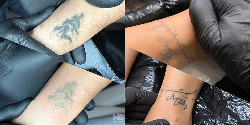 Laser tattoo removal: Before and After