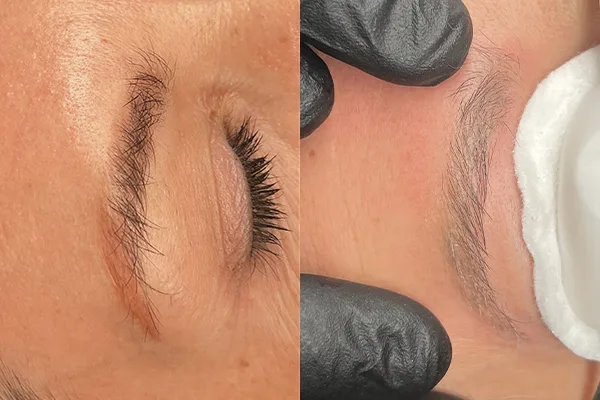 Brows Laser Removal