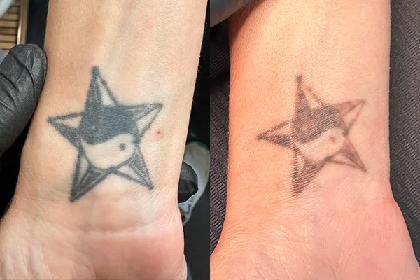 Tattoo Removal