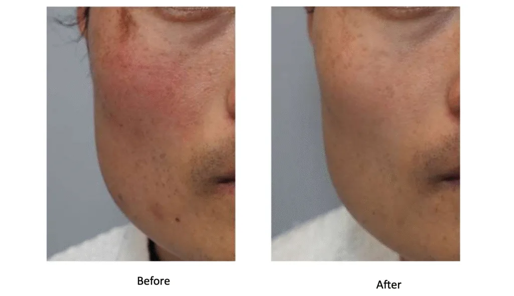 Facial Flushing - Rosacea