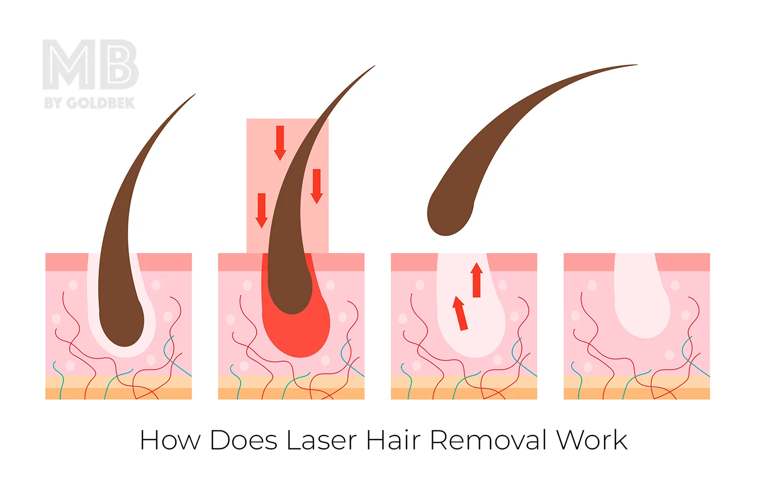 How Does Laser Hair Removal Work?