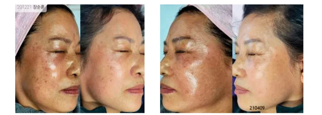 Laser Pigmentation Removal
