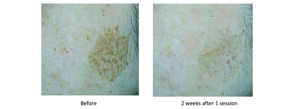 Skin Pigmentation