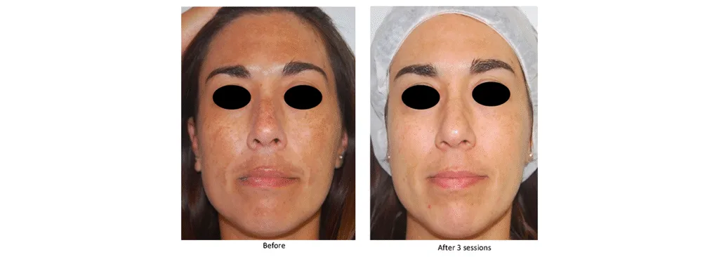 Skin Pigmentation Removal