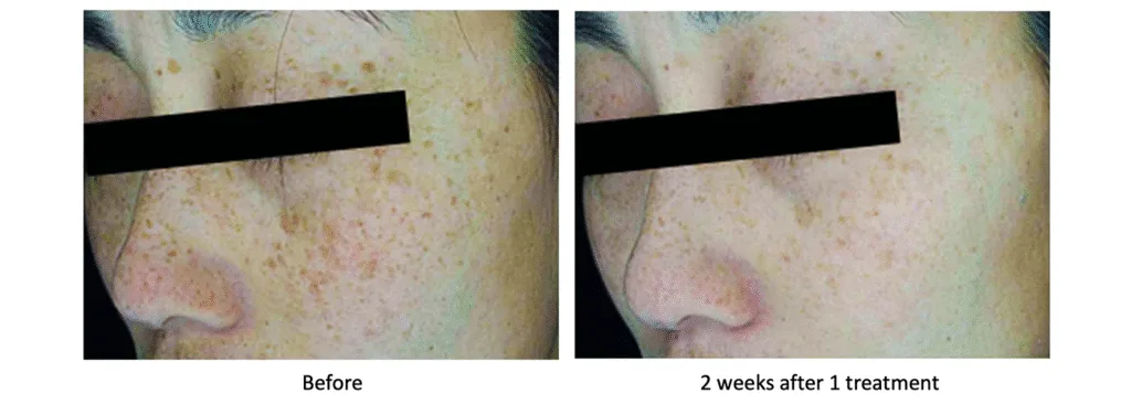 Sun Spots on the skin