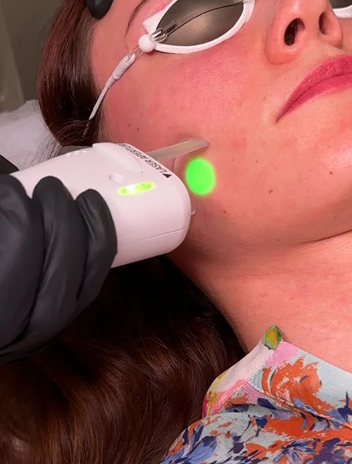 Laser Facial Treatments