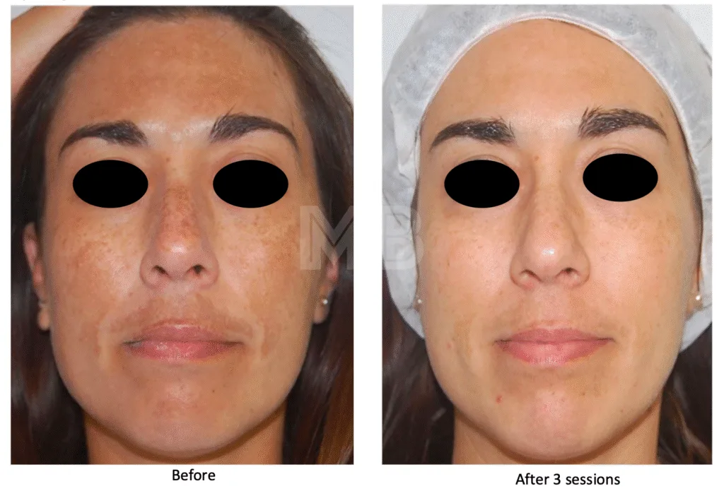 remove pigmentation from face permanently