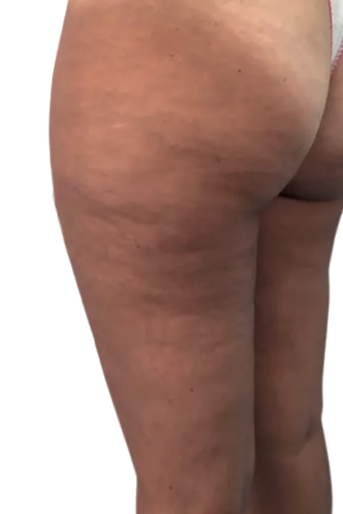 Hips Before using Arosha