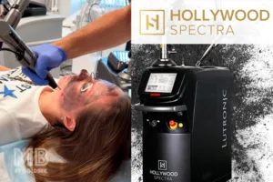 Carbon Laser Peel