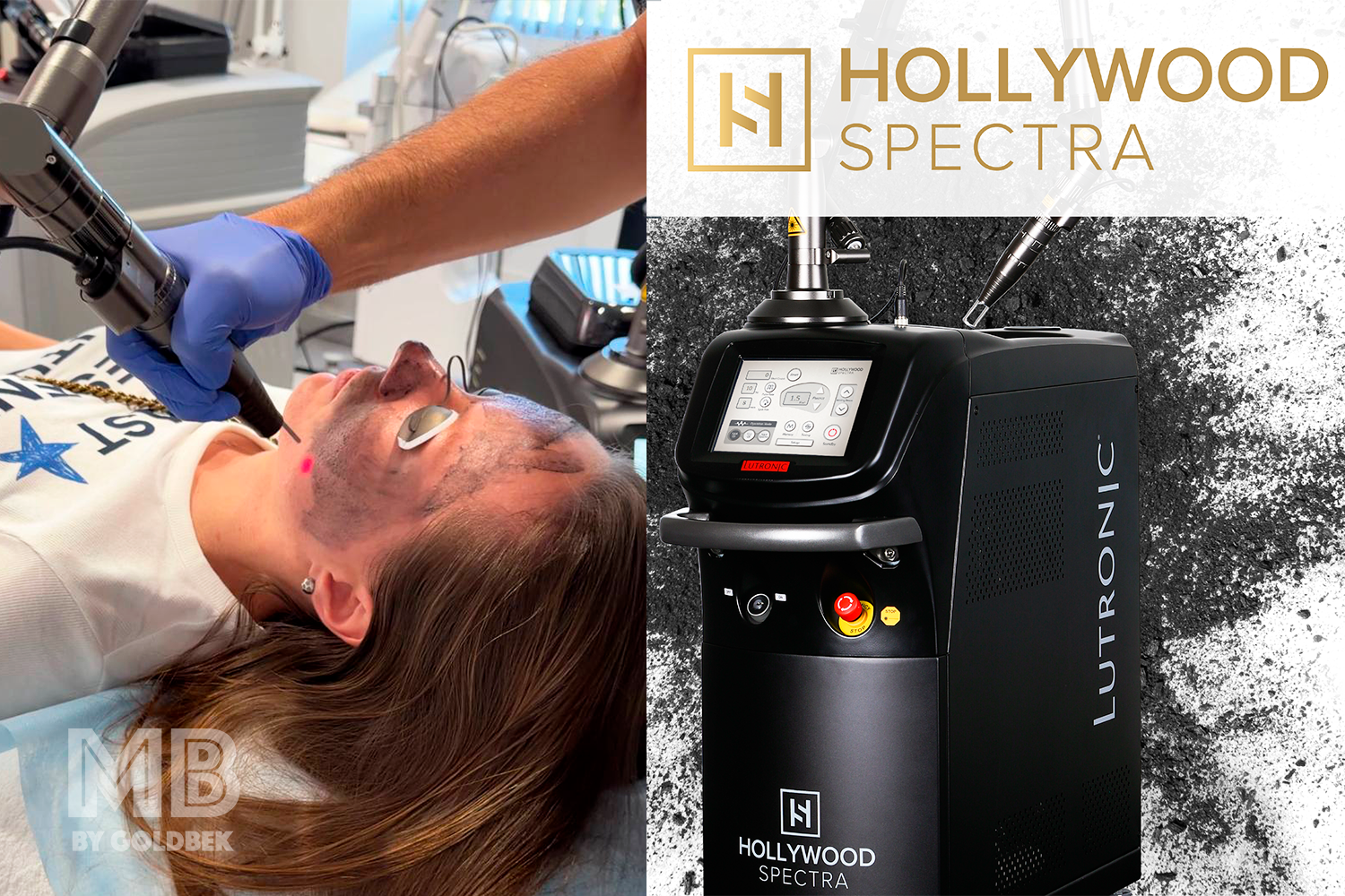 Hollywood Carbon Laser Peel: The Celebrity Facial with Zero Downtime
