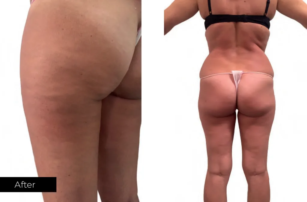 result-before-after-body-sculpt-treatments