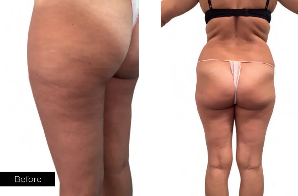 result-before-body-sculpt