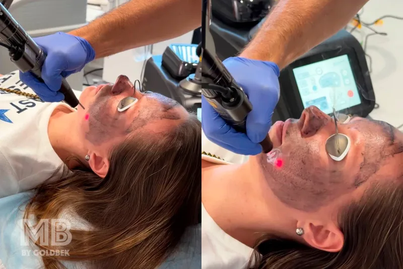 Hollywood Carbon Laser Peel